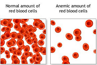 Anemia: Know the Signs
