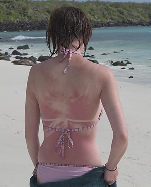 Sunburn For A Sun Tan?