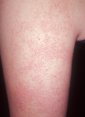 Pimples On Arms