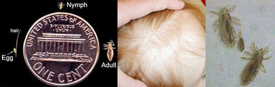 Head Lice: Do You Know the Facts?