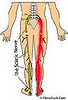 What's the Deal With:  Sciatica