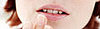 Canker Sores Are No Crack up
