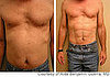 Six-Pack Surgery? 