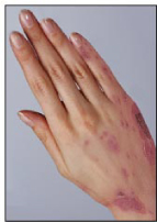 How Can I Clear Up My Eczema?