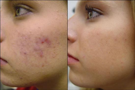 Arrivederci Acne Scars!