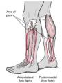The Skinny On: Shin Splints